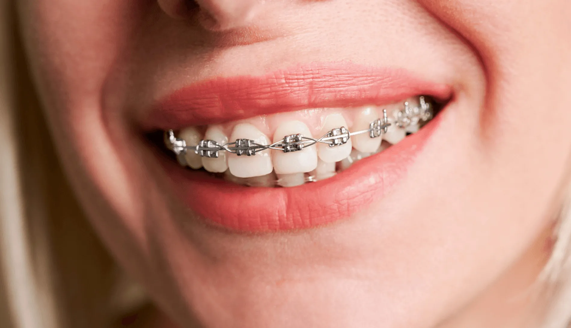 Transformă-ți zâmbetul cu aparat dentar modern: inovații și beneficii pe care nu le ignori